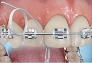Perfect Smile ortho Flossing steps